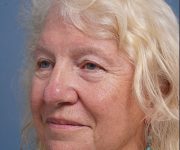 before brow lift left angle view female patient case 2123