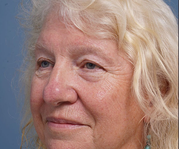 before brow lift left angle view female patient case 2123