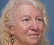 before brow lift right angle view female patient case 2123