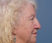 before brow lift right side view female patient case 2123