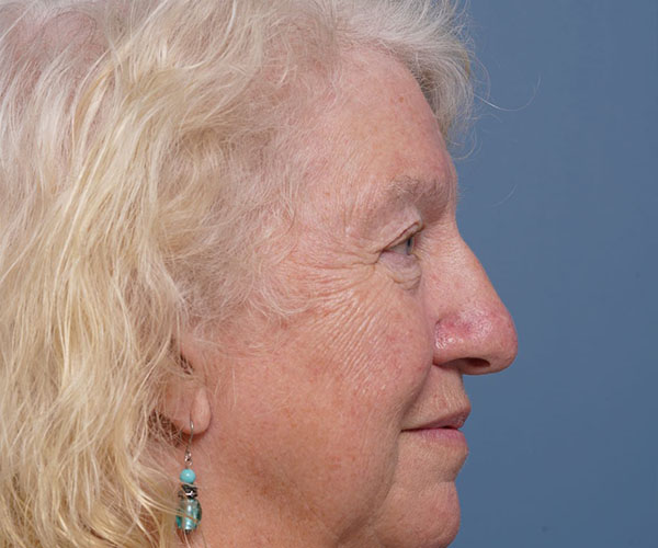 before brow lift right side view female patient case 2123