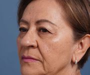 before brow lift left angle view female patient case 2116