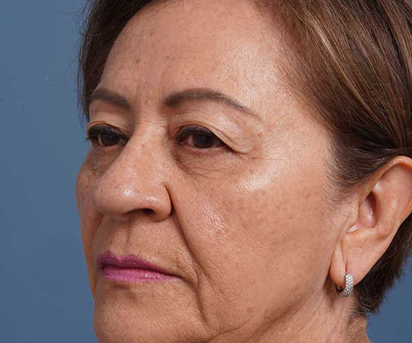 before brow lift left angle view female patient case 2116