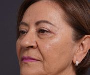 after brow lift left angle view female patient case 2116