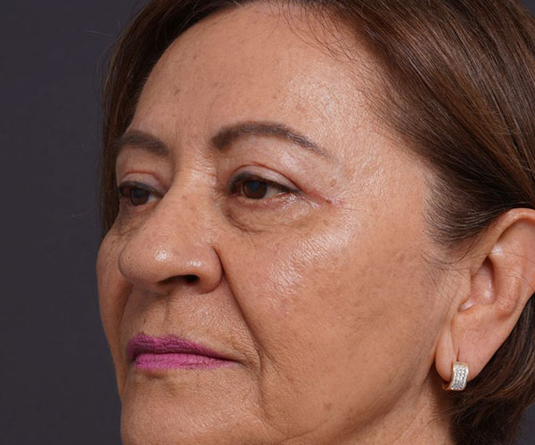 after brow lift left angle view female patient case 2116