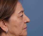 before brow lift right side view female patient case 2116