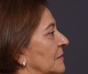 after brow lift right side view female patient case 2116