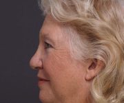 after brow lift left side view female patient case 2123