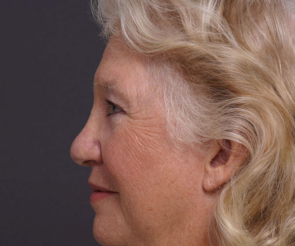 after brow lift left side view female patient case 2123
