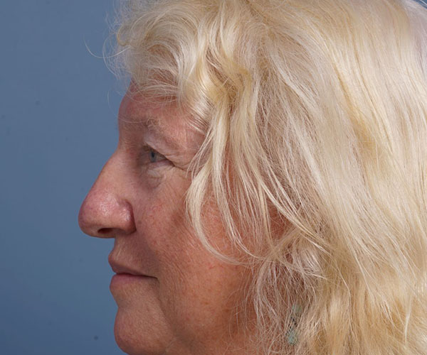 before brow lift left side view female patient case 2123