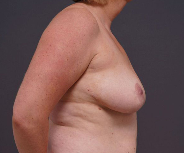 before breast augmentation right side view female patient case 2048