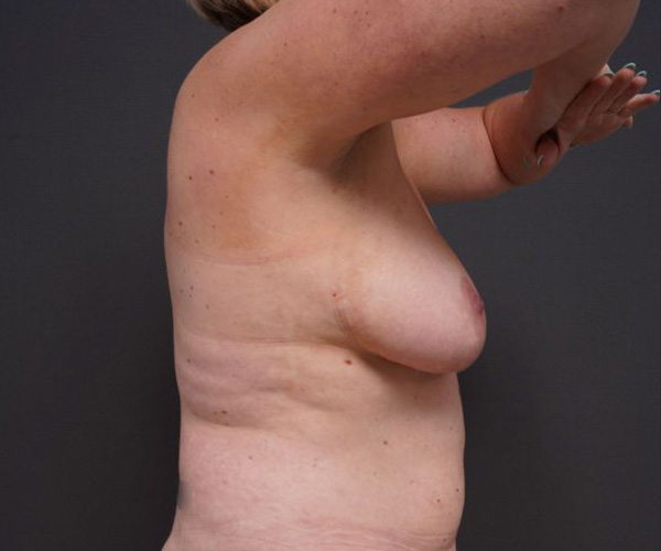 before breast augmentation right side arms up view female patient case 2048