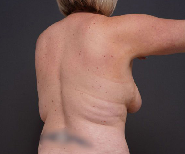 before breast augmentation right angle arms up view female patient case 2048