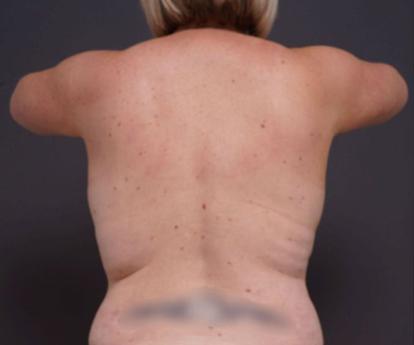 before breast augmentation back view female patient case 2048