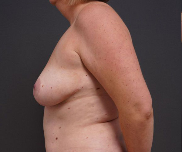 before breast augmentation left side view female patient case 2048