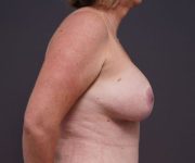after breast augmentation right side view female patient case 2048