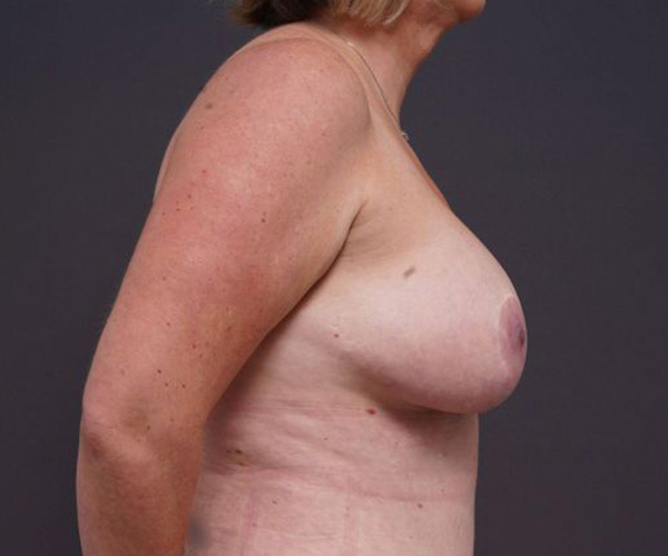 after breast augmentation right side view female patient case 2048