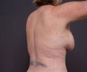after breast augmentation right angle arms up view female patient case 2048