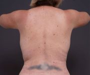after breast augmentation back view female patient case 2048