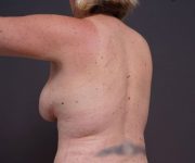 after breast augmentation left angle arms up view female patient case 2048