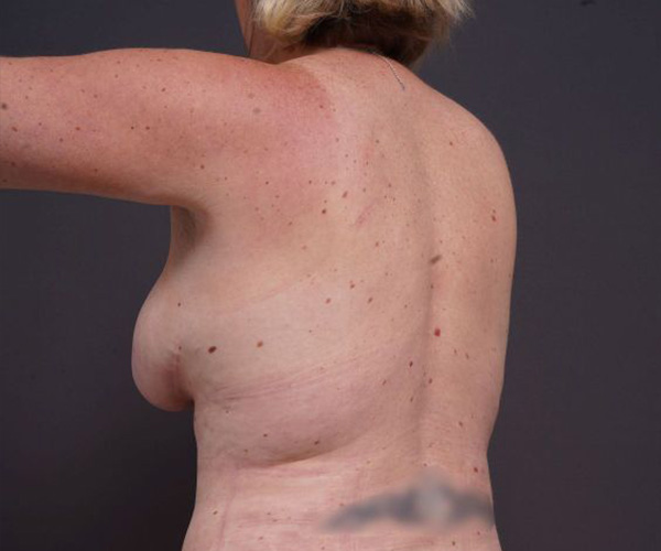 after breast augmentation left angle arms up view female patient case 2048