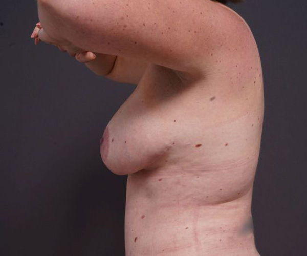 after breast augmentation left side arms up view female patient case 2048