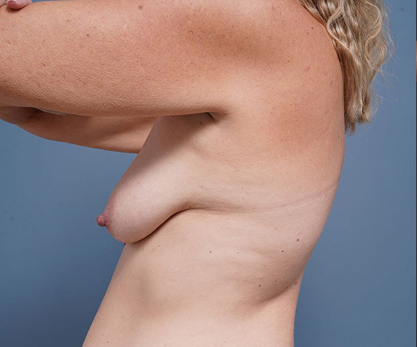 before breast lift left side arms up view female patient case 2373