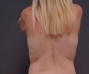 after breast lift back view female patient case 2373