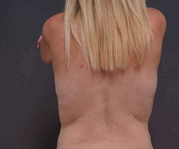after breast lift back view female patient case 2373