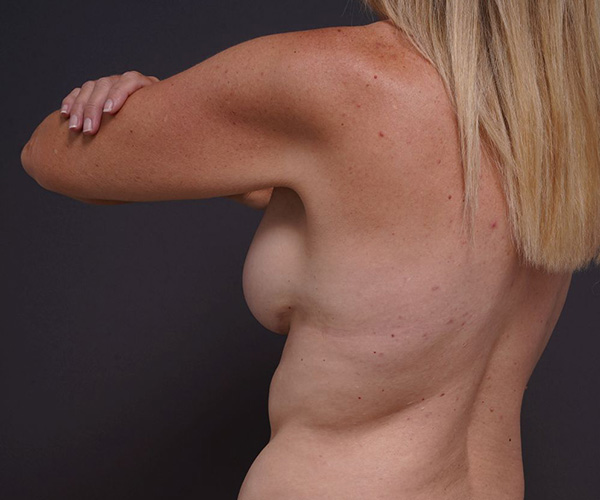 after breast lift left angle arms up view female patient case 2373