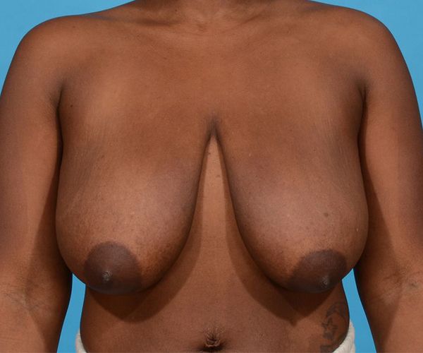 before breast lift with implants front view female patient case 2370