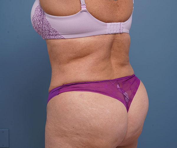 after tummy tuck left rear angle view of female patient 2302