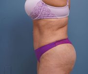 after tummy tuck left side view of female patient 2302