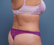 after tummy tuck rear right angle view of female patient 2302