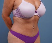 after tummy tuck right angle view of female patient 2302