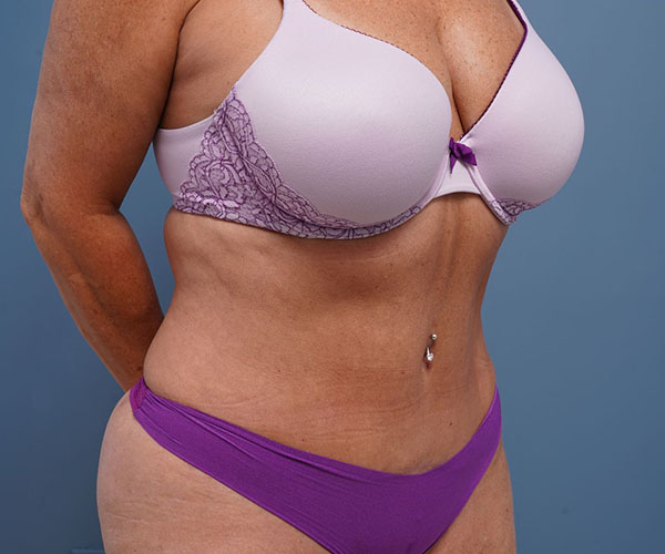 after tummy tuck right angle view of female patient 2302