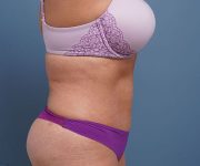 after tummy tuck right side view of female patient 2302